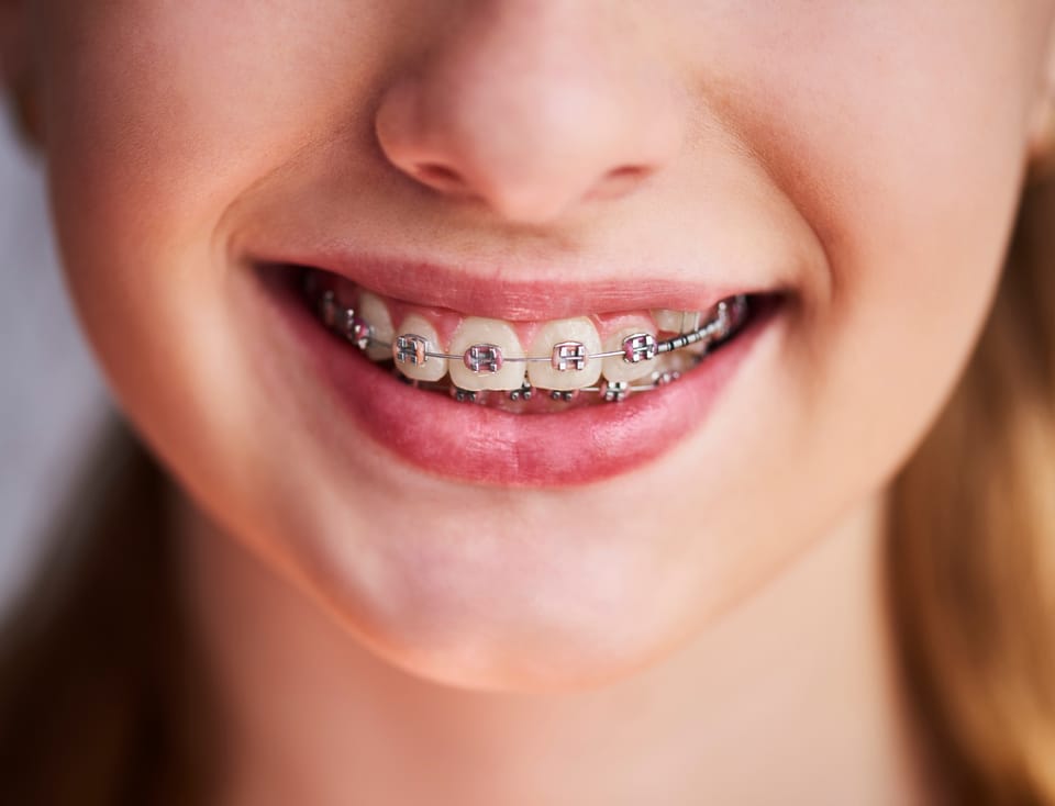 Braces are cool again